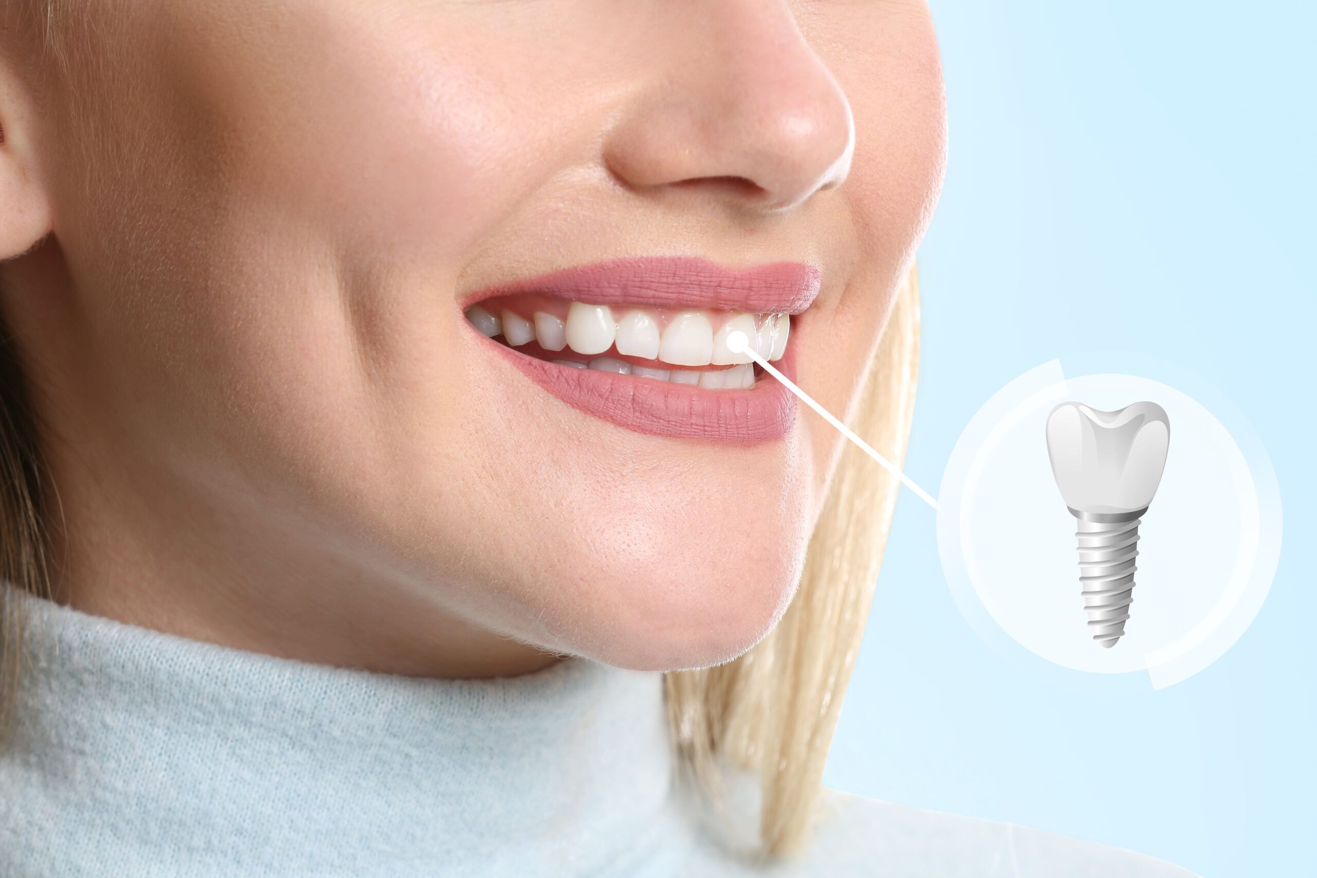 Revolutionizing Smiles: The Latest Advancements in Dental Implants