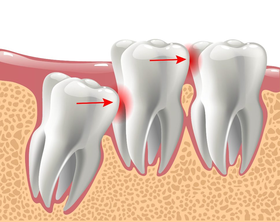 A Comprehensive Guide To Wisdom Teeth Removal Rb Dental Excellence